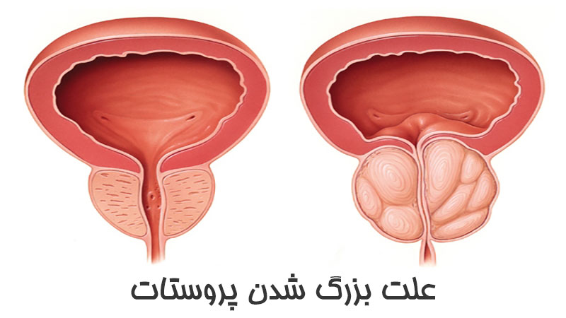 علت بزرگ شدن پروستات