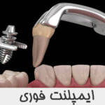 ایمپلنت فوری