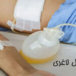 درن عمل لاغری