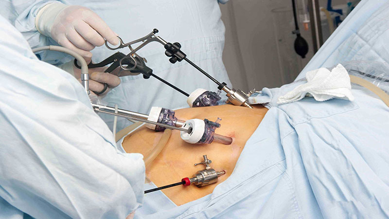 جراحی با روش لاپاراسکوپی