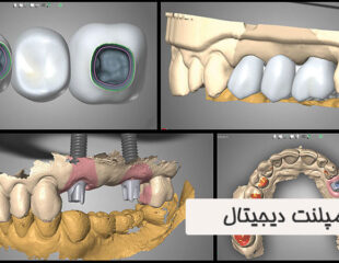 ایمپلنت دیجیتال