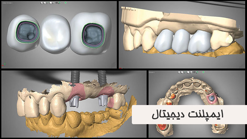 ایمپلنت دیجیتال