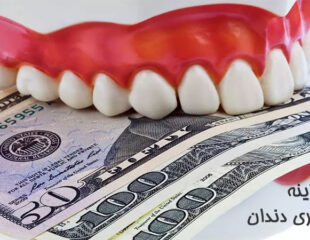 هزینه جرم گیری دندان
