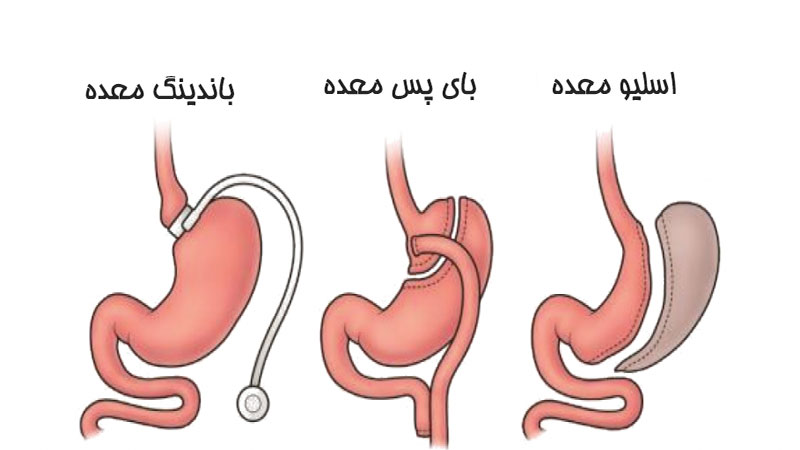 جراحی لاغری