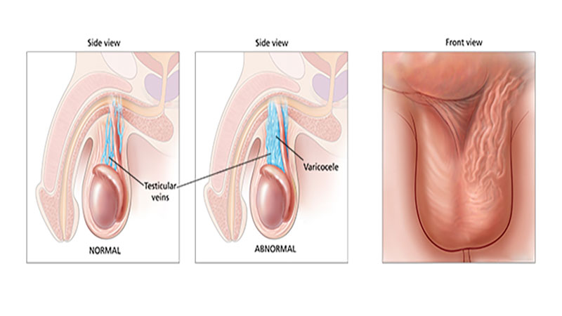 واریکوسل و سرطان بیضه
