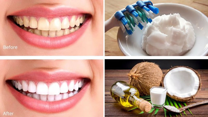 نحوه سفید کردن دندان با روغن نارگیل
