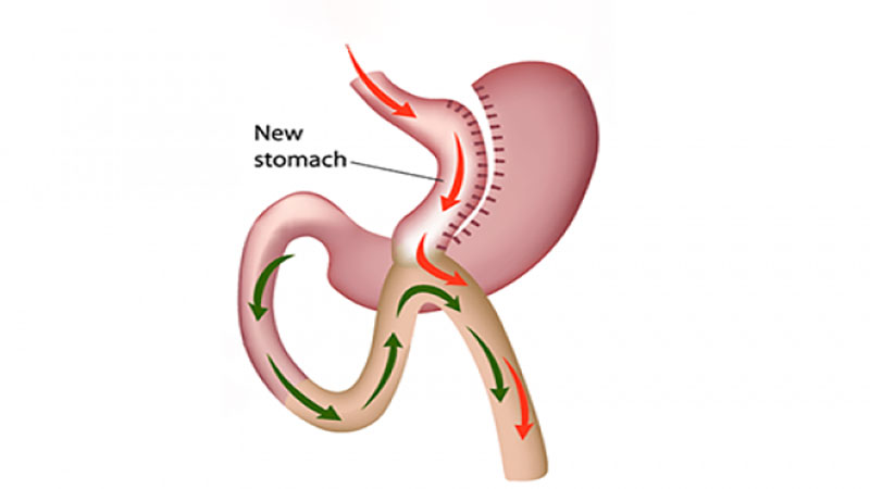 روند جراحی بای پس معده