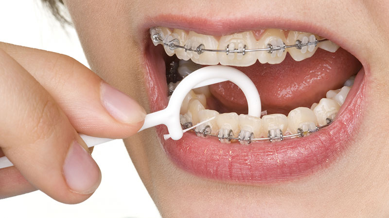 نخ دندان کشیدن در طول درمان ارتودنسی