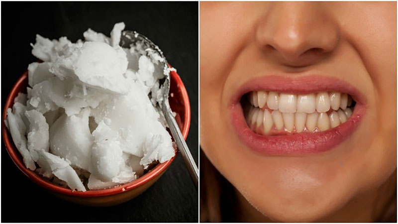 استفاده از روغن نارگیل برای سفید کردن دندان