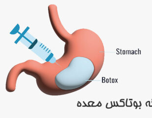 هزینه بوتاکس معده