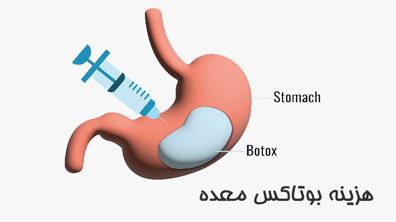 هزینه بوتاکس معده