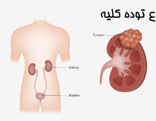 انواع توده کلیه