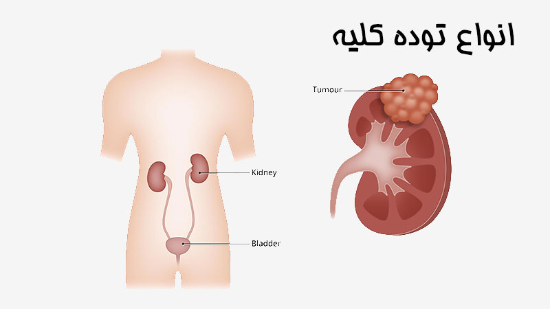 انواع توده کلیه