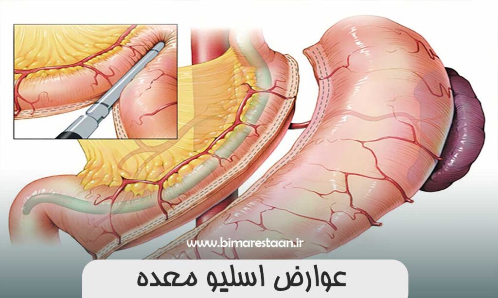عوارض اسلیو معده