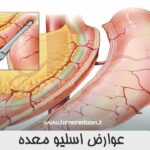 عوارض اسلیو معده