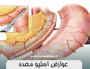 عوارض اسلیو معده