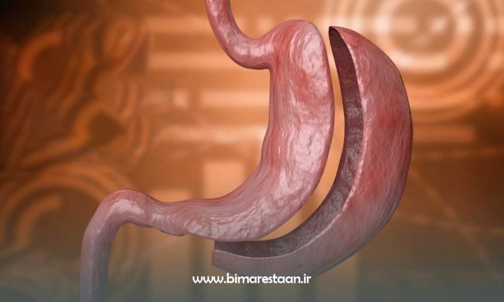 این عمل لاغری چگونه به کاهش وزن افراد کمک می‌کند؟