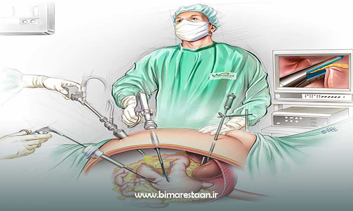 مزایای اسلیو معده
