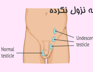 بیضه نزول نکرده