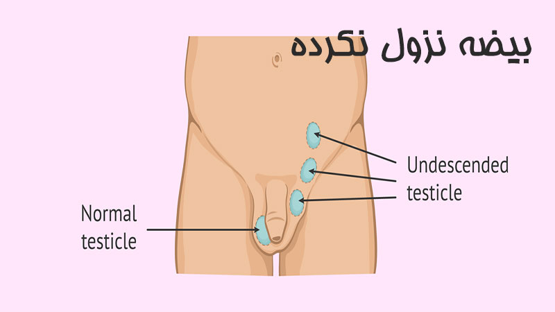 بیضه نزول نکرده