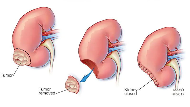 روش های درمان توده های کلیوی