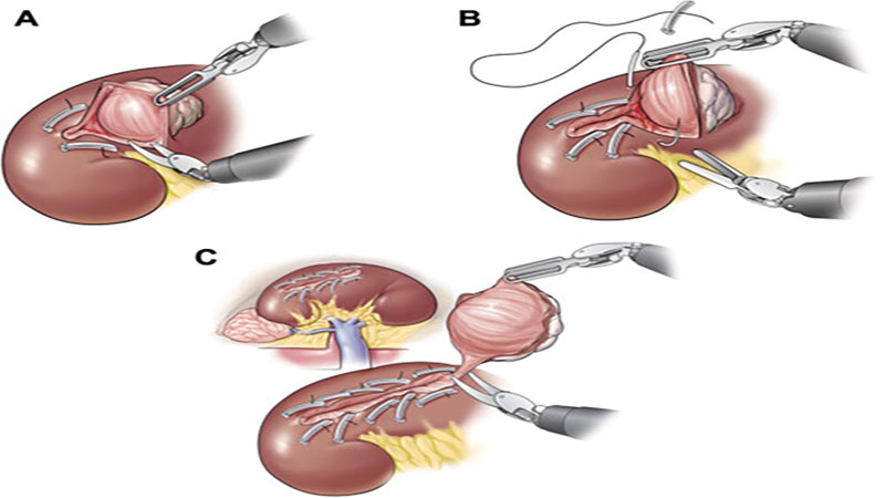 جراحی لاپاراسکوپی کلیه