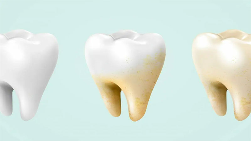 علت شایع زرد شدن دندان ها