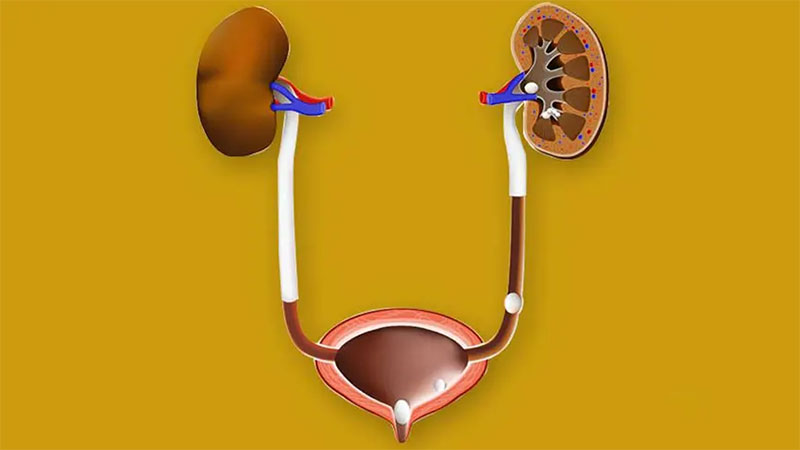 علت سنگ مثانه چیست؟