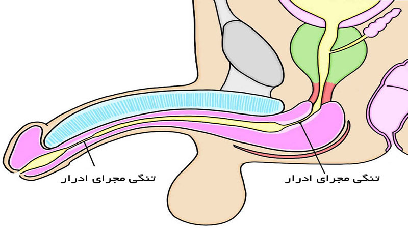 تنگی مجاری ادراری چیست؟