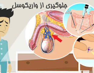 Prevention of varicocele