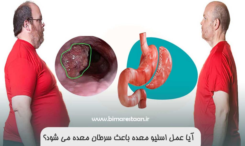 آیا عمل اسلیو معده باعث سرطان معده می شود