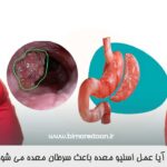 آیا عمل اسلیو معده باعث سرطان معده می شود