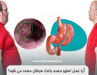 آیا عمل اسلیو معده باعث سرطان معده می شود
