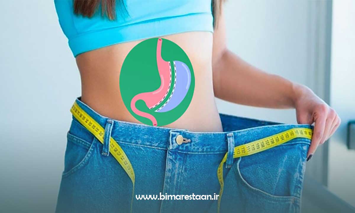 عمل اسلیو معده چیست؟