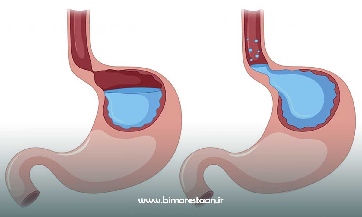 ریفلاکس معده به مری