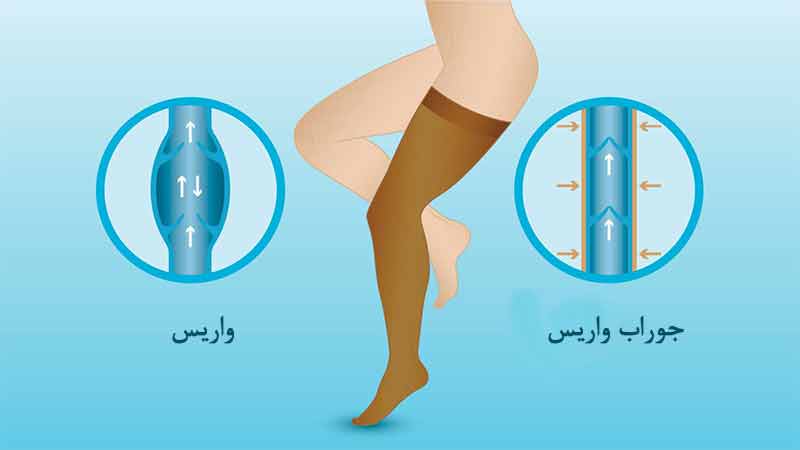 جوراب واریس چیست؟