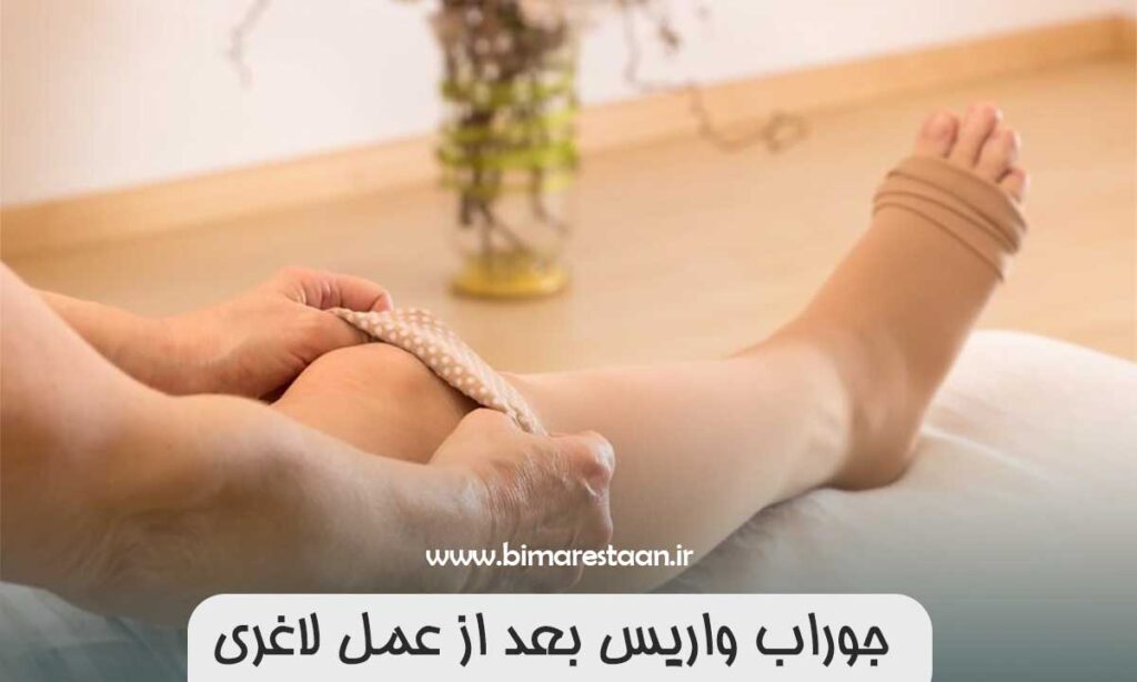 جوراب واریس بعد از عمل لاغری