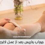 جوراب واریس بعد از عمل لاغری جوراب واریس بعد از عمل لاغری