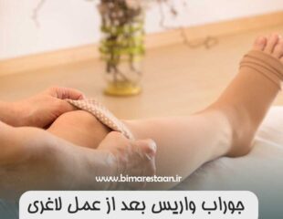 جوراب واریس بعد از عمل لاغری