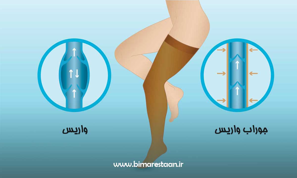 جوراب واریس چیست؟