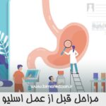 مراحل قبل از عمل اسلیو