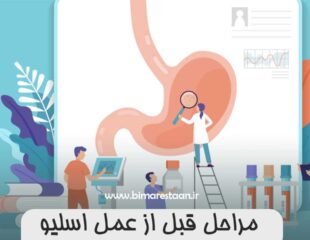 مراحل قبل از عمل اسلیو