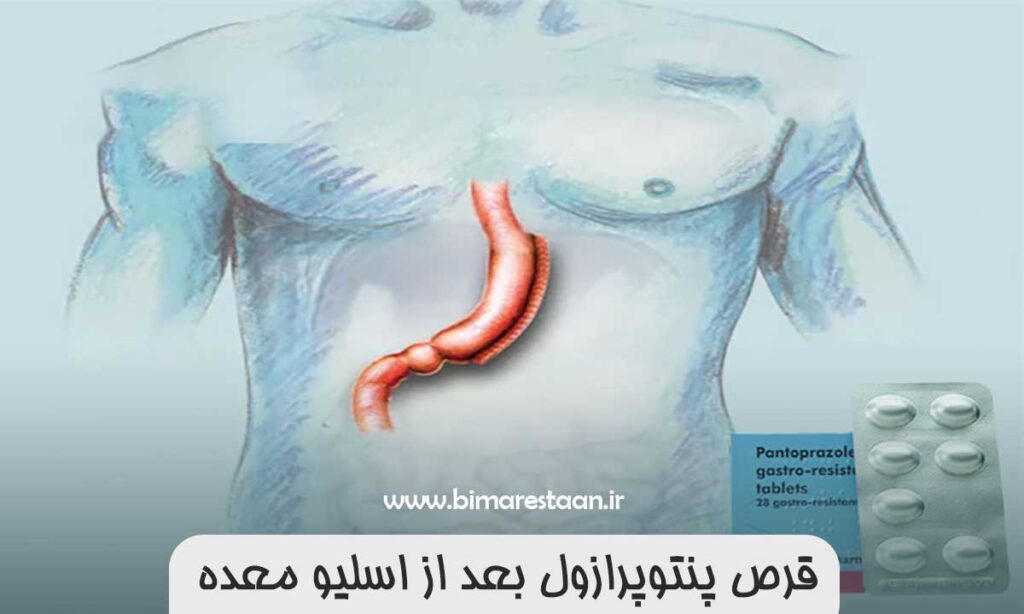 قرص پنتوپرازول بعد از اسلیو معده