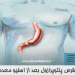 قرص پنتوپرازول بعد از اسلیو معده