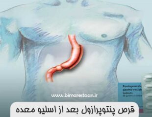 قرص پنتوپرازول بعد از اسلیو معده