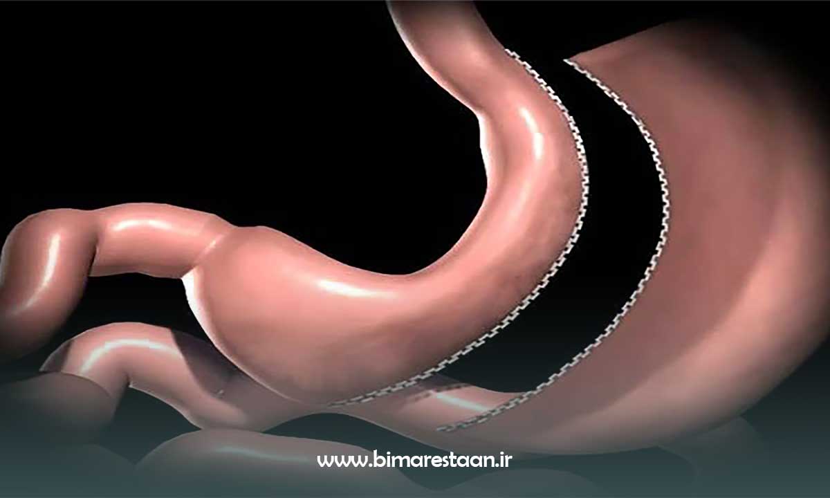 عمل اسلیو معده