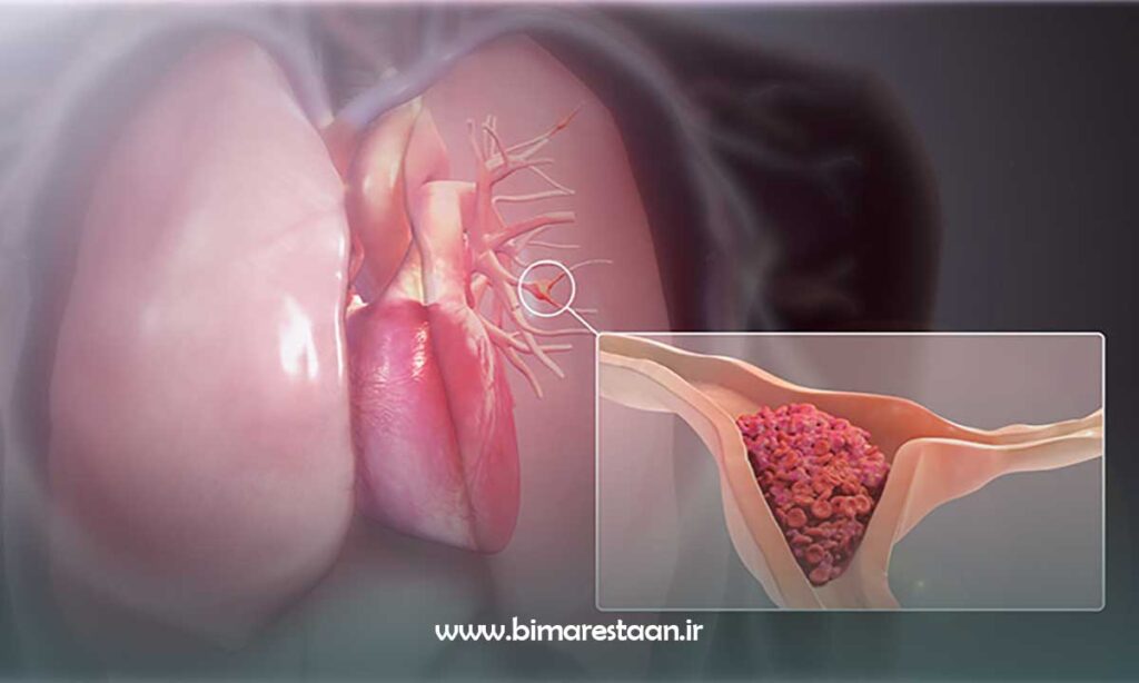 آمبولی بعد از جراحی اسلیو معده