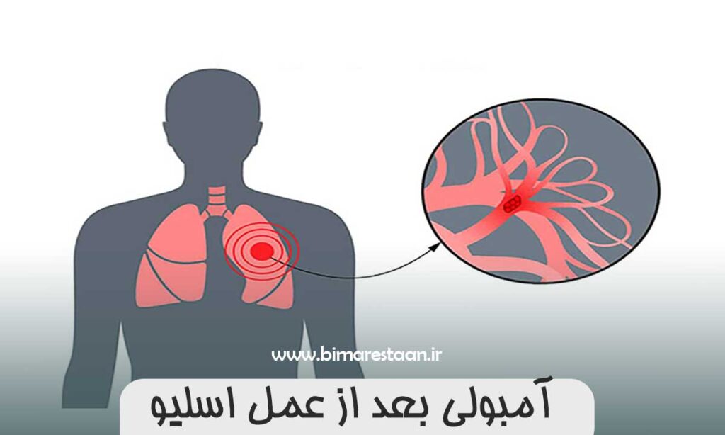 آمبولی بعد از عمل اسلیو