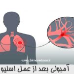 آمبولی بعد از عمل اسلیو