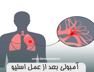 آمبولی بعد از عمل اسلیو